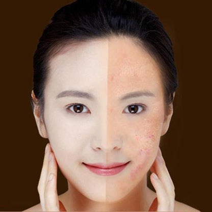 Blue Light Therapy Acne Laser Pen Soft Scar Wrinkle Removal Treatment Device Skin Care Beauty Equipment - Globentra